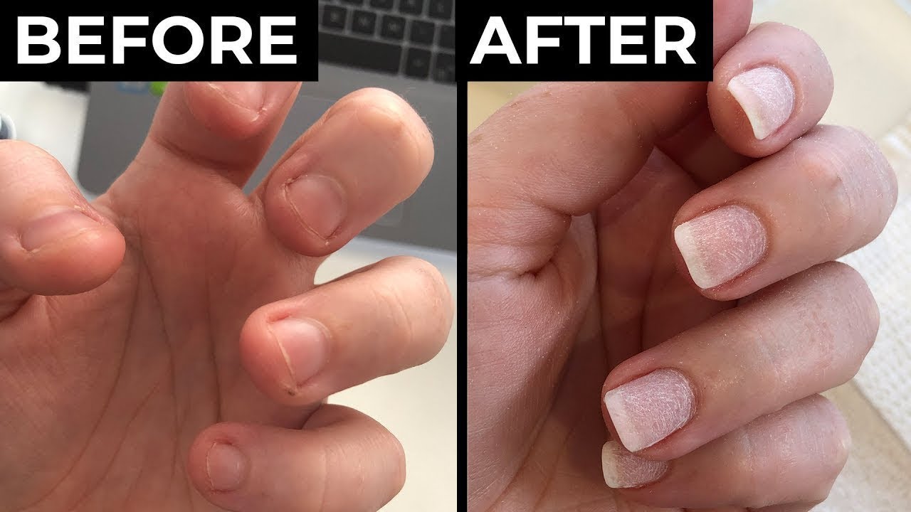 This is why you should stop biting the skin off round your fingernails  immediately – The Sun | The Sun